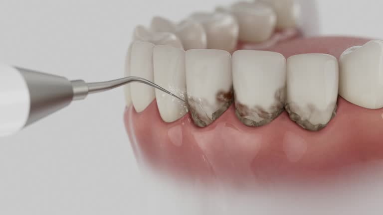 Reliable Dental Implants contractor in Rotonda, FL by Smile Center Dentistry